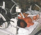 Cuore: intervento su neonata