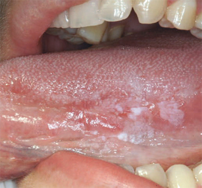 Lesione precancerosa del bordo linguale con aspetti bianchi e rossi