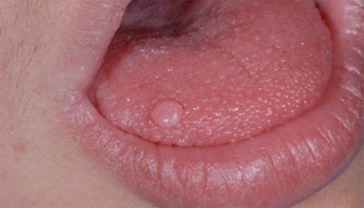 Fig. 4 Mucocele a livello del dorso linguale