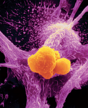 Micrografia elettronica a scansione di un macrofago (viola) che attacca una cellula tumorale